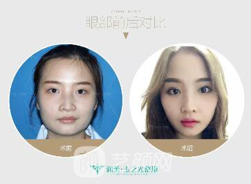 成都玉之光双眼皮案例