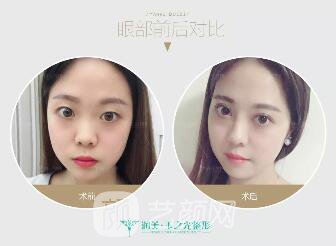 成都玉之光双眼皮案例