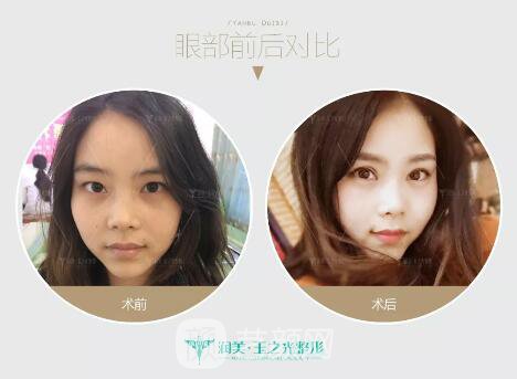 成都玉之光双眼皮案例