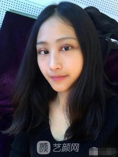 萍乡优美整形李清芳全切双眼皮照片 拯救眼睛不对称