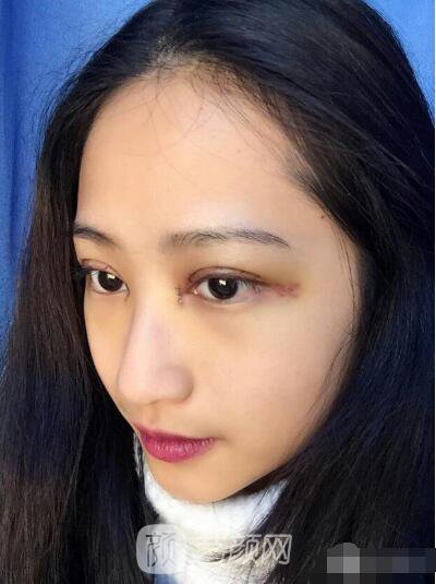 萍乡优美整形李清芳全切双眼皮照片 拯救眼睛不对称