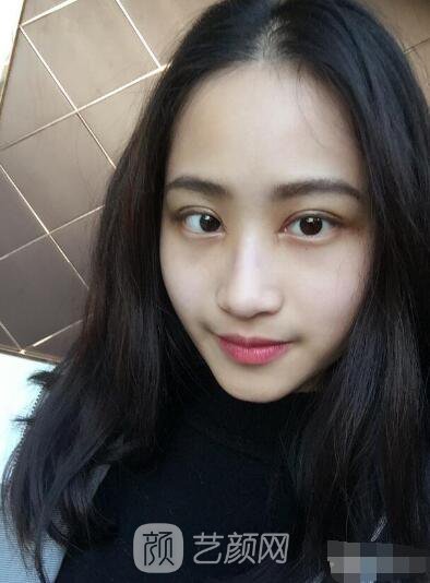 萍乡优美整形李清芳全切双眼皮照片 拯救眼睛不对称