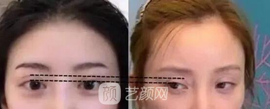 天津美莱整形对双眼皮的误解之——“越宽越好看?”