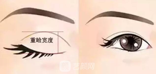 天津美莱整形对双眼皮的误解之——“越宽越好看?”