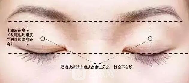 天津美莱整形对双眼皮的误解之——“越宽越好看?”
