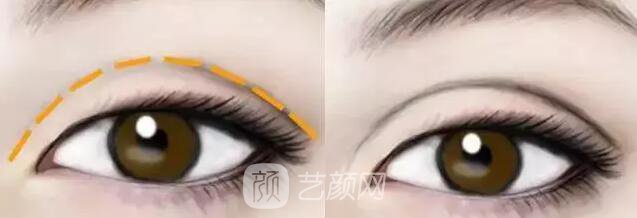 天津美莱整形对双眼皮的误解之——“越宽越好看?”