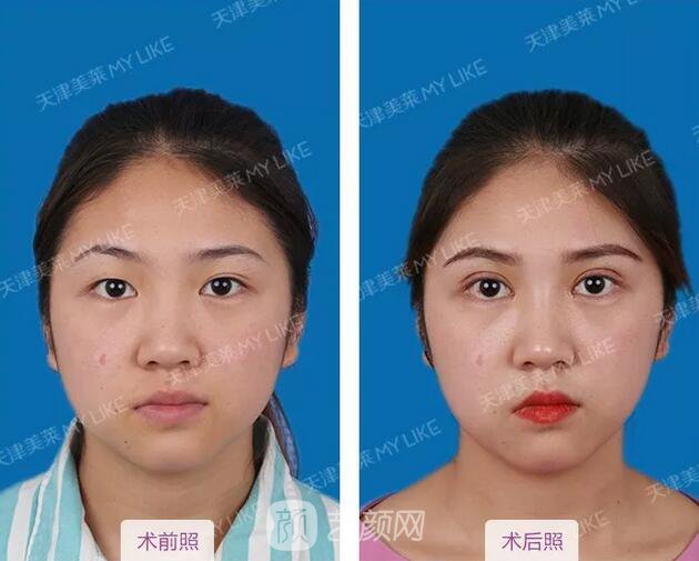 天津美莱整形对双眼皮的误解之——“越宽越好看?”
