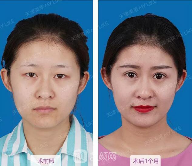 天津美莱整形对双眼皮的误解之——“越宽越好看?”