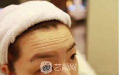 怎么消除抬头纹？