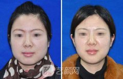 注射瘦脸图片
