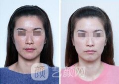 光子嫩肤价格是多少