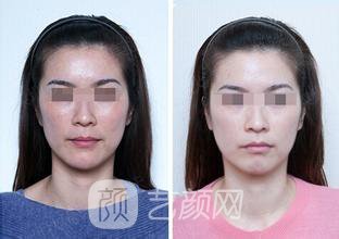 光子嫩肤价格是多少