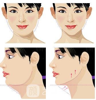 如何去双下巴，抽脂减双下巴怎么样