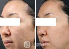 磨皮去痘坑果怎么样？