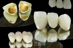 金属烤瓷牙价格是多少钱？