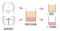 自体脂肪填充颞部价格是多少钱？