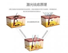 点痣后要注意什么？激光点痣后的注意事项？