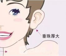 玻尿酸丰耳垂果能维持多久？