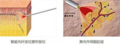等离子光纤溶脂的果怎么样？