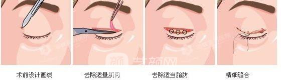 5s重睑术价格是多少，果好不好