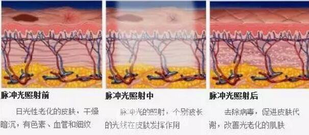 光子嫩肤的优势