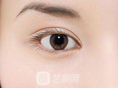 生物焊接双眼皮需要多少钱