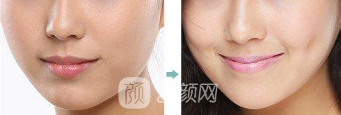 人造酒窝的价格和果