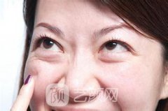 去眼袋手术吗