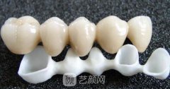 烤瓷牙多少钱？