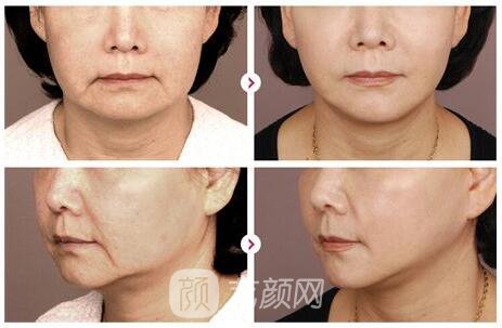 热玛吉紧致手术手术果好吗