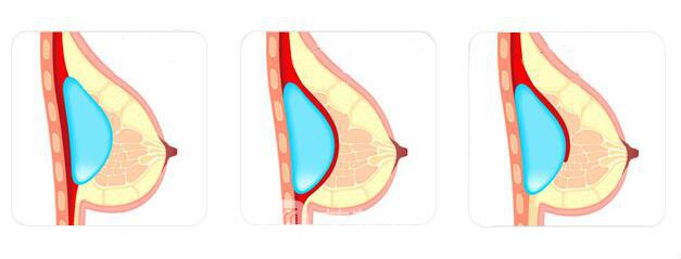 麦格假体需要多少钱呢