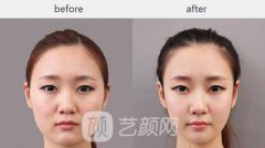 下颌角整形需要多少钱呢
