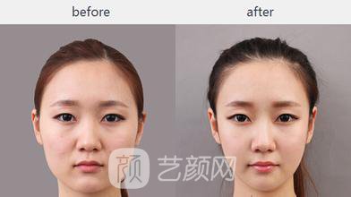 下颌角整形需要多少钱呢