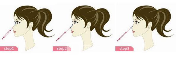 微晶瓷注射隆鼻需要多少钱呢