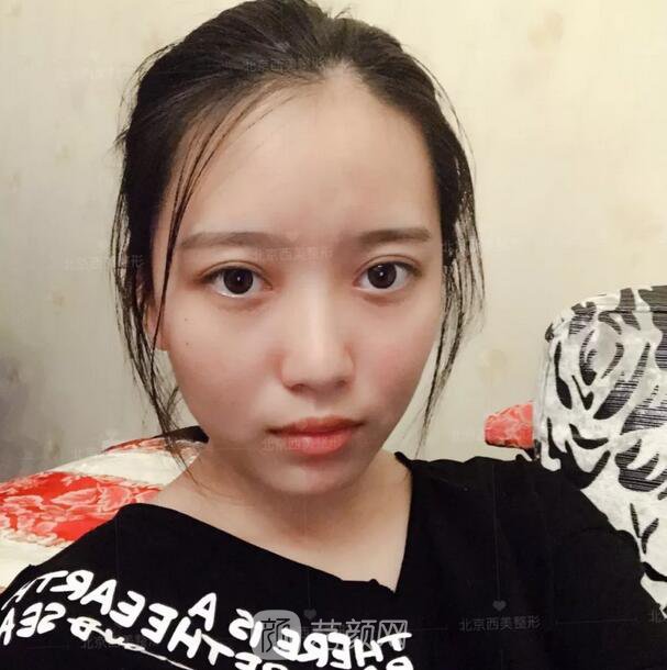 北京西美整形医院全切双眼皮真人案例图|内附恢复过程哦~
