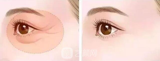 北京艺星整形Yestar分龄祛眼袋真实案例图分享哦~