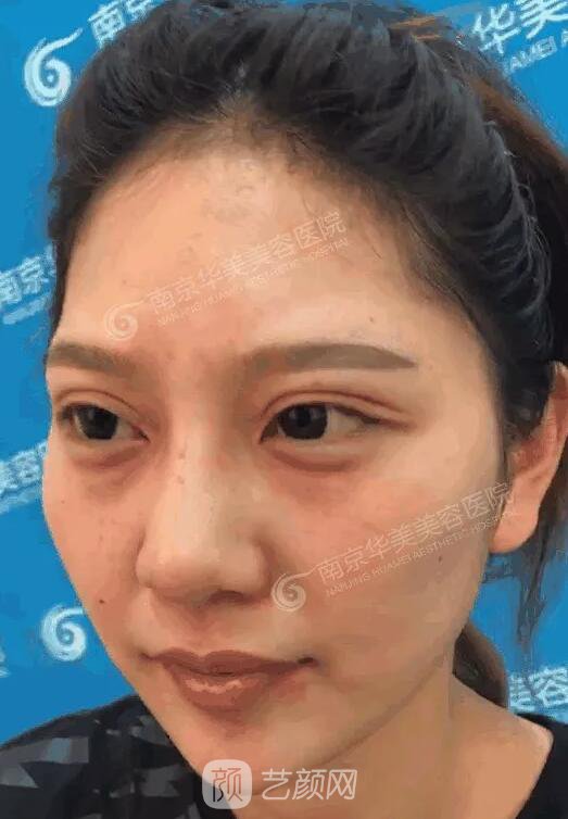 南京华美裴旭芳怎么样?自体脂肪填充全脸真人案例