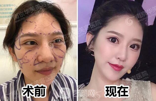 南京华美裴旭芳怎么样?自体脂肪填充全脸真人案例