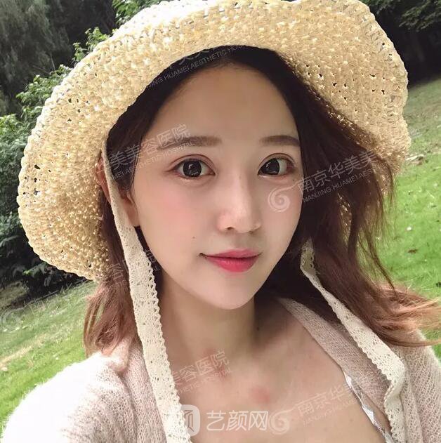 南京华美裴旭芳怎么样?自体脂肪填充全脸真人案例