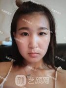 天津伊美尔整形医院案例分享，蒙古妹纸不平凡逆袭记!