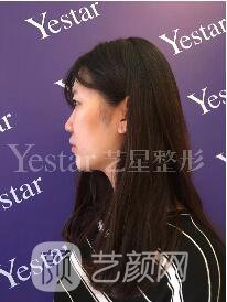 南京艺星割双眼皮案例半年图