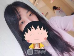 成都娇点姜宇禄双眼皮修复案例，重获新生！