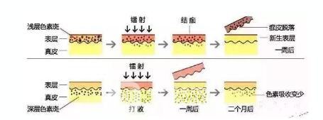 激光祛斑果怎么样，会上皮肤嘛，怎么才能成功祛斑