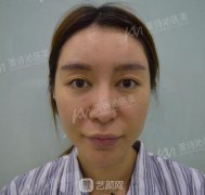 北京美诗沁面部吸脂案例图分享，马上变精致小脸~