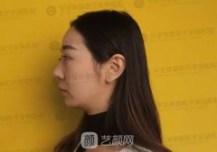 华美紫馨整形医院隆鼻修复案例恢复全过程|内附图哦