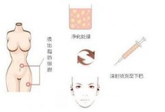 自体脂肪填充到底需要多少钱呢