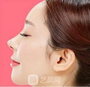 蒜头鼻怎么办，矫正价格是多少