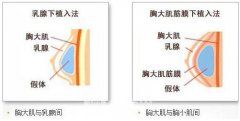 美国曼托妙桃假体隆胸多少钱？