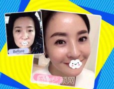 打一支美白多少钱