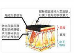 黑脸娃娃费用是多少